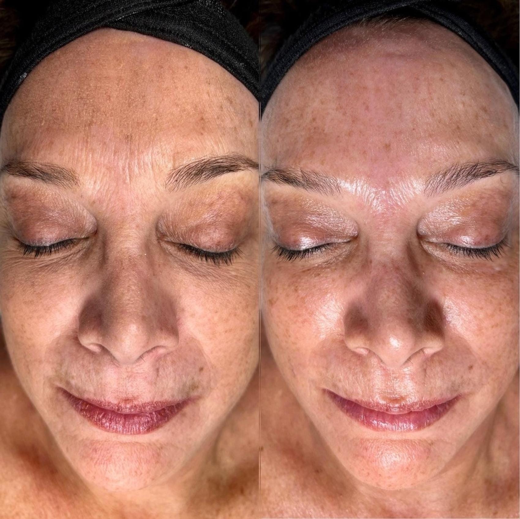 hydrafacial 47 front detail